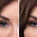 Woman’s Face Before And After Cosmetic Procedure